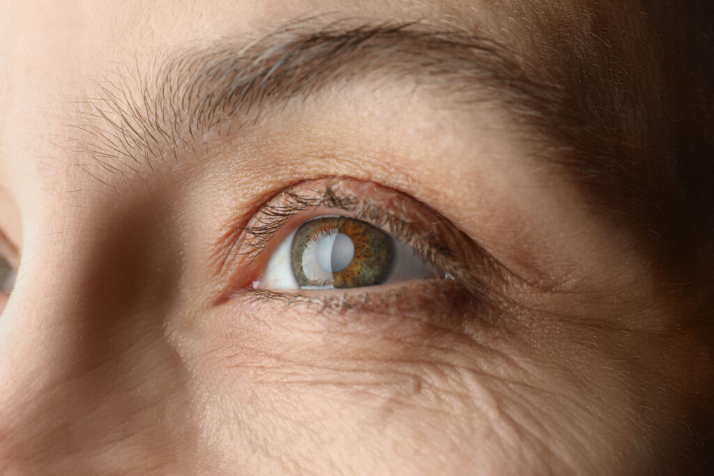 Closeup view of mature woman with cataract thumbnail